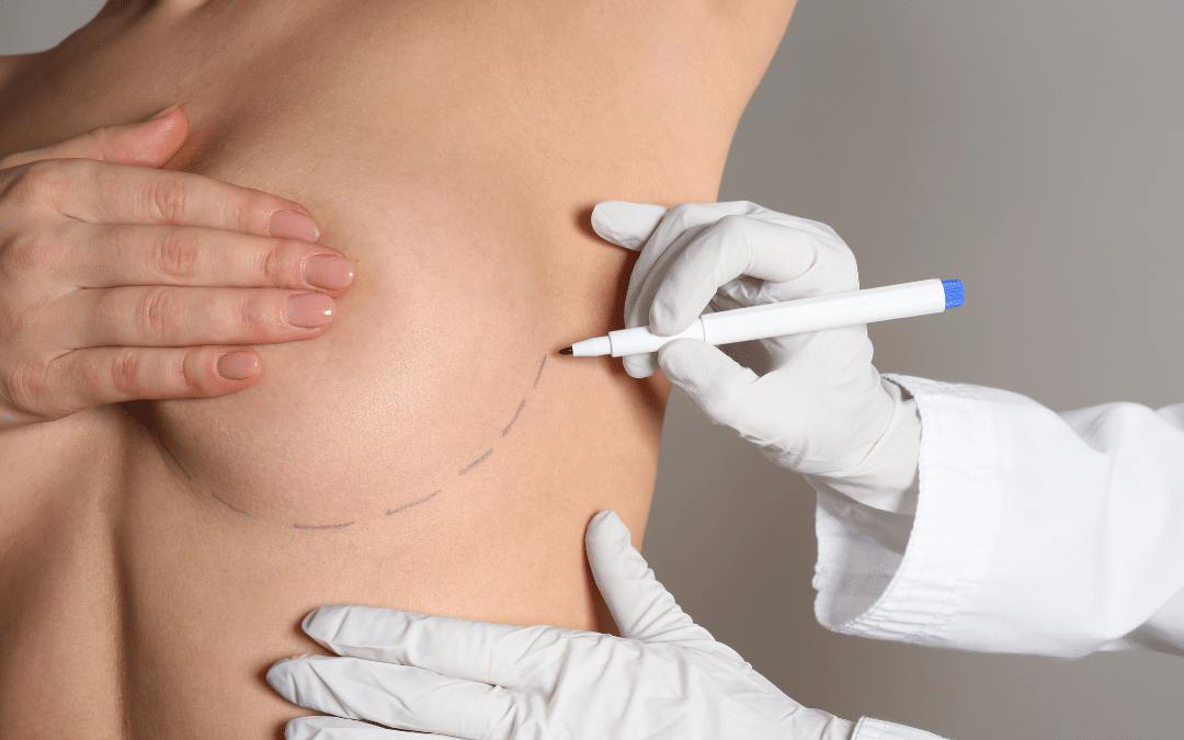 cirugia mamaria